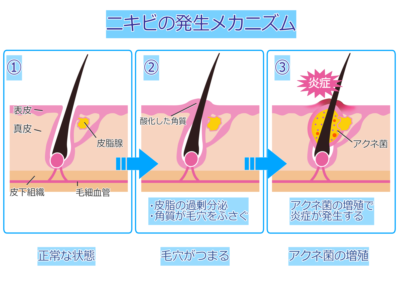 ニキビが発生するメカニズム